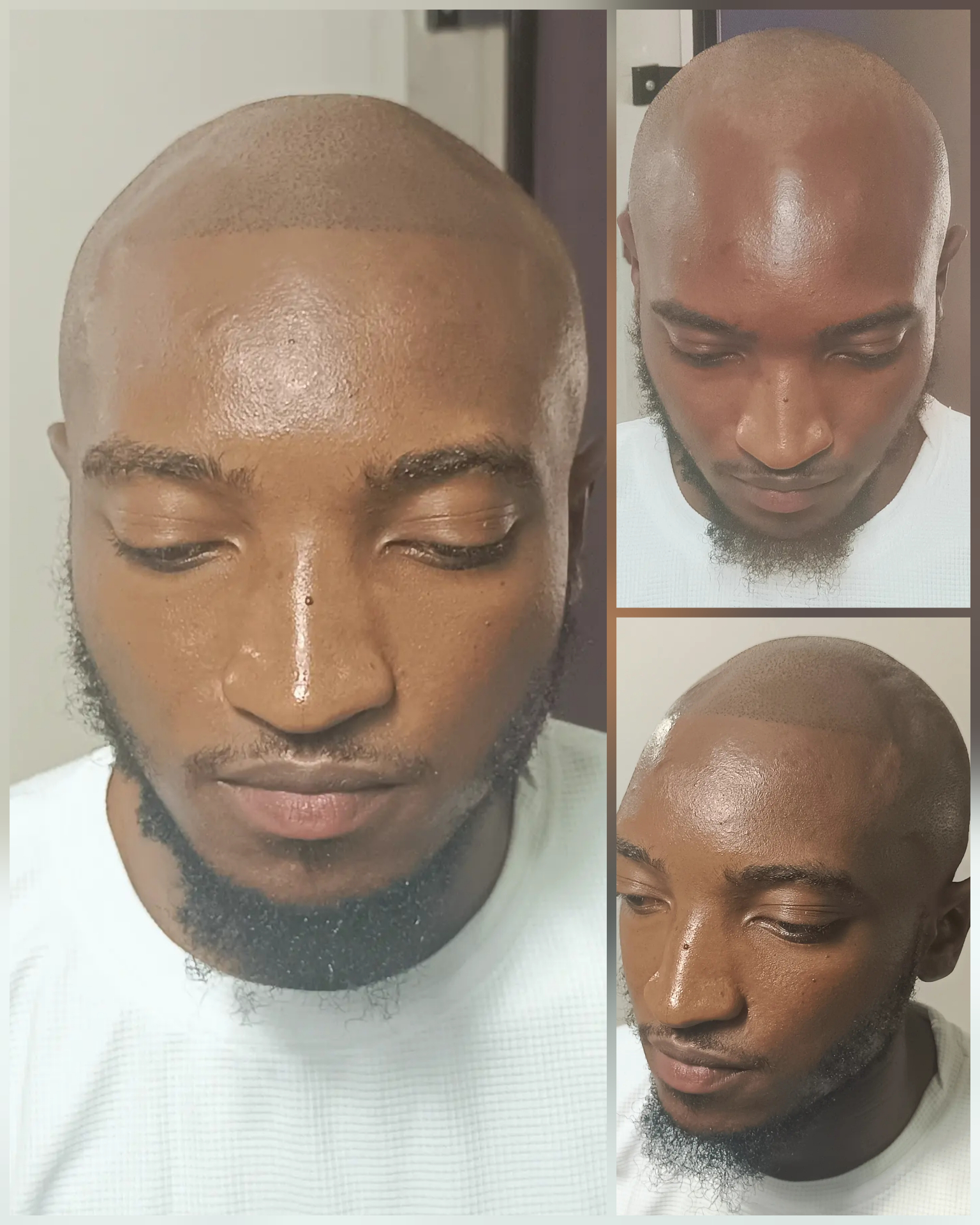 Scalp micropigmentation result